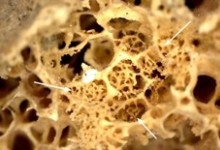 Ancient skeleton is the earliest case of cancer yet detected