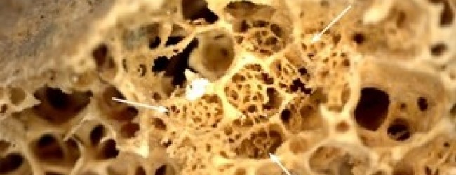 Ancient skeleton is the earliest case of cancer yet detected